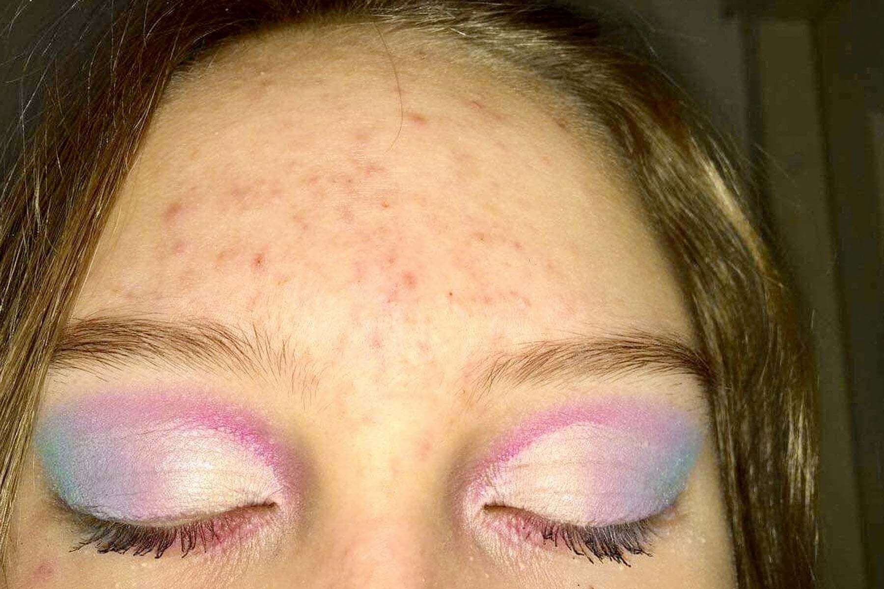 Mikään ei tehonnut akneen ja ekseemaan